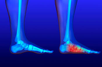 Flat feet treatment in the Palm Beach County, FL: West Palm Beach (Royal Palm Beach, Loxahatchee, Riviera Beach, Boca Del Mar, Belle Glade) areas