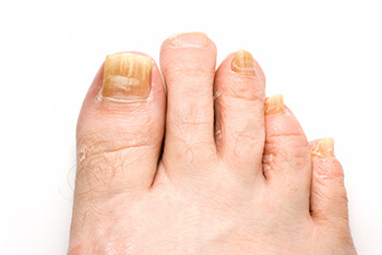 Toenail fungus treatment in the Palm Beach County, FL: West Palm Beach (Royal Palm Beach, Loxahatchee, Riviera Beach, Boca Del Mar, Belle Glade)