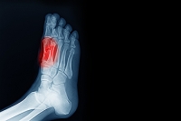 Seeking Podiatric Care for Sesamoiditis