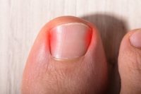 Types of Ingrown Toenails